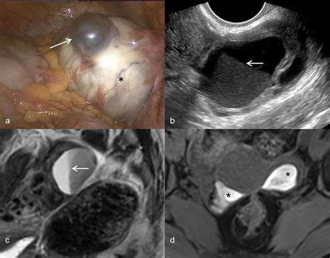 endometriosis cyst on right ovary